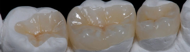 surrey dental Inlays and Onlays