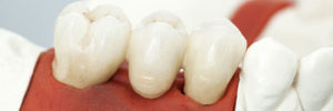 dental crown lengthening