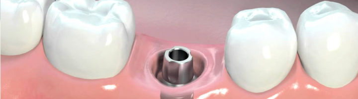 surrey dental implants